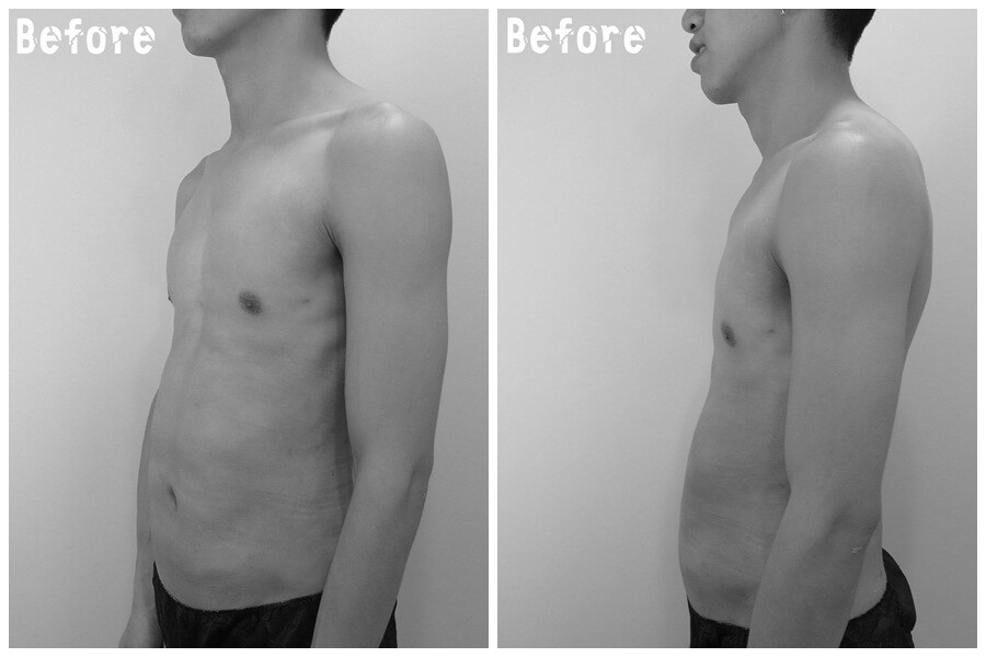 腹部抽脂打造六塊腹肌/人魚線術前照片