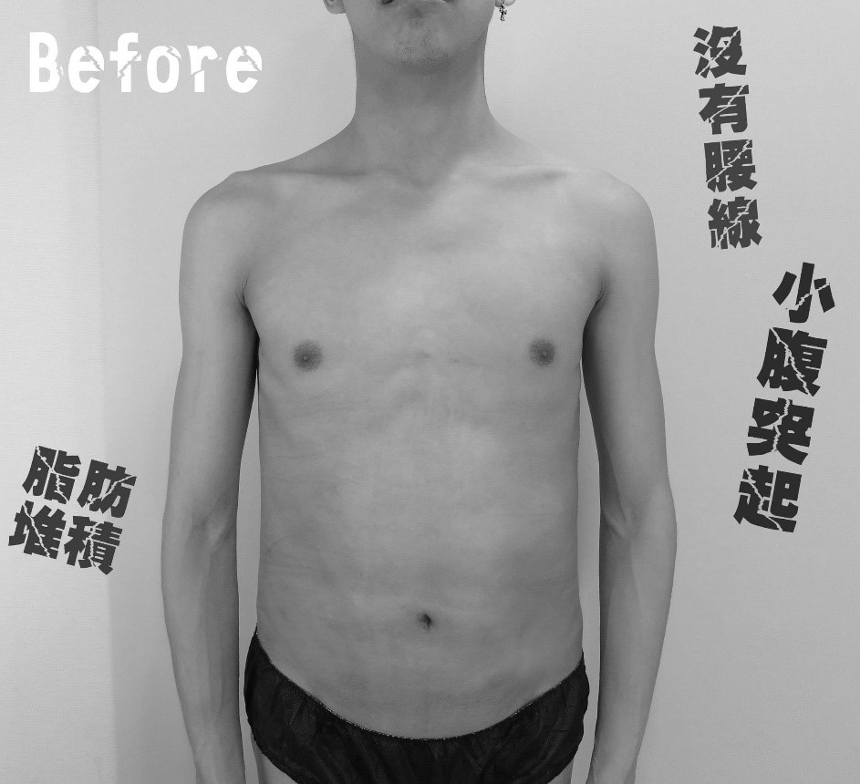 腹部抽脂打造六塊腹肌/人魚線術前照片