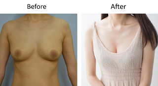 自體脂肪豐胸術後案例心得分享+腹部抽脂案例